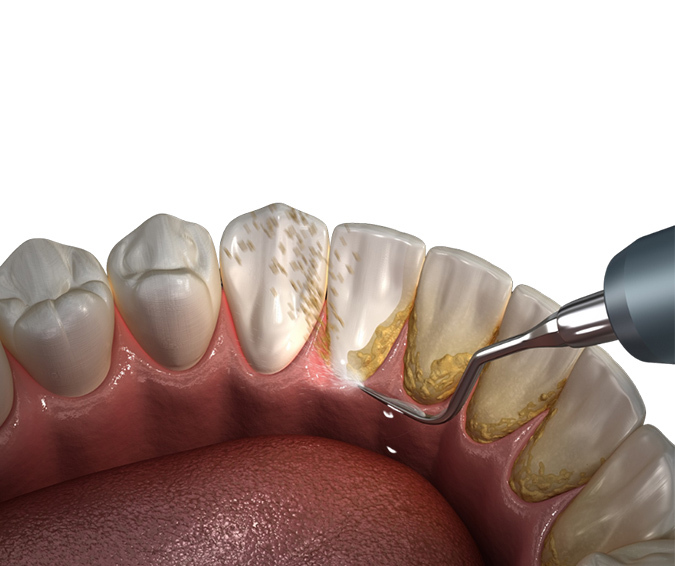 Dental cleaning image