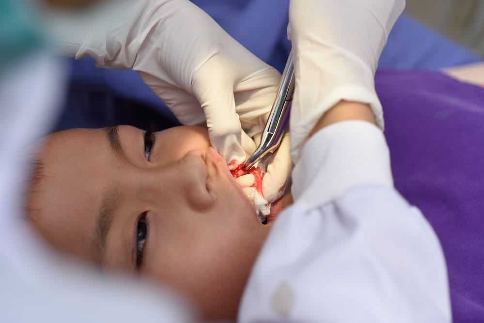 Dental extraction image