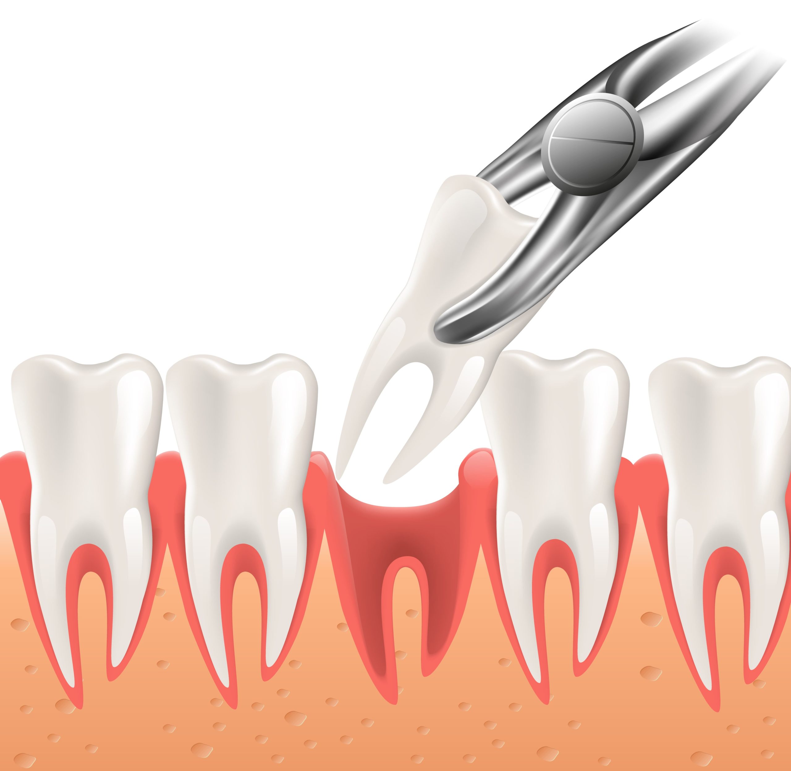 tooth extraction image